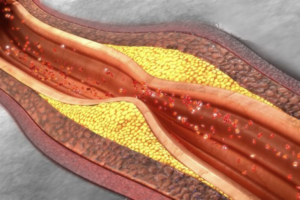 Lipoproteína(a) está em alta: o que você precisa saber sobre esse marcador de risco cardiovascular